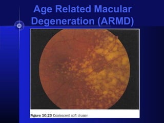 ARMD with basic retinal anatomy and management of armd | PPTX