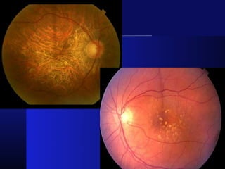 ARMD with basic retinal anatomy and management of armd | PPTX