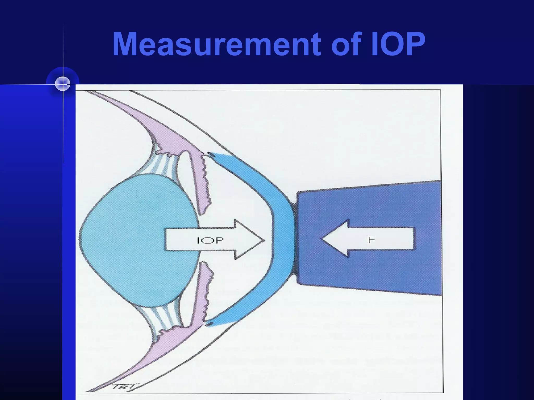 Measurement of IOP
 