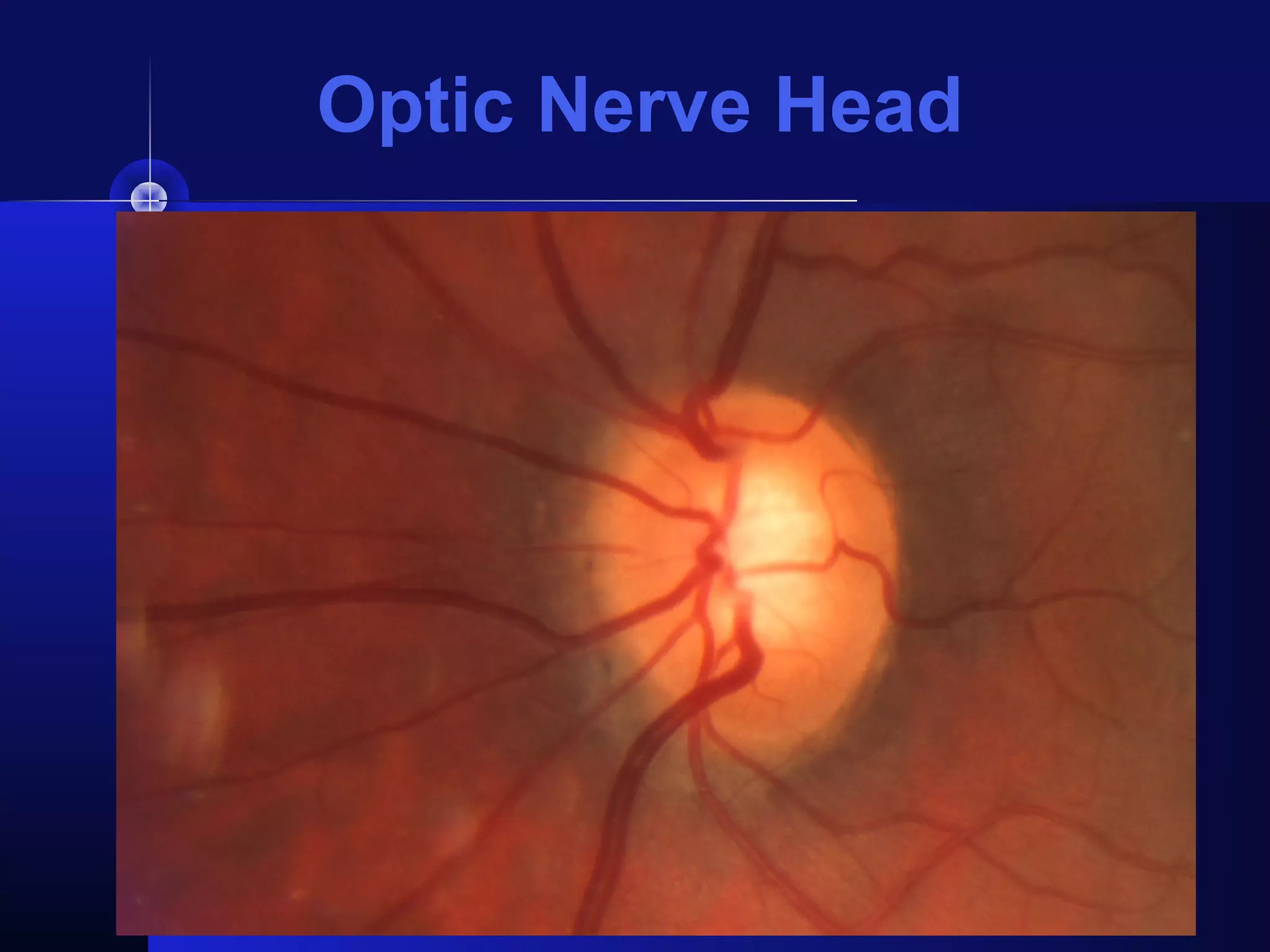 Optic Nerve Head
 