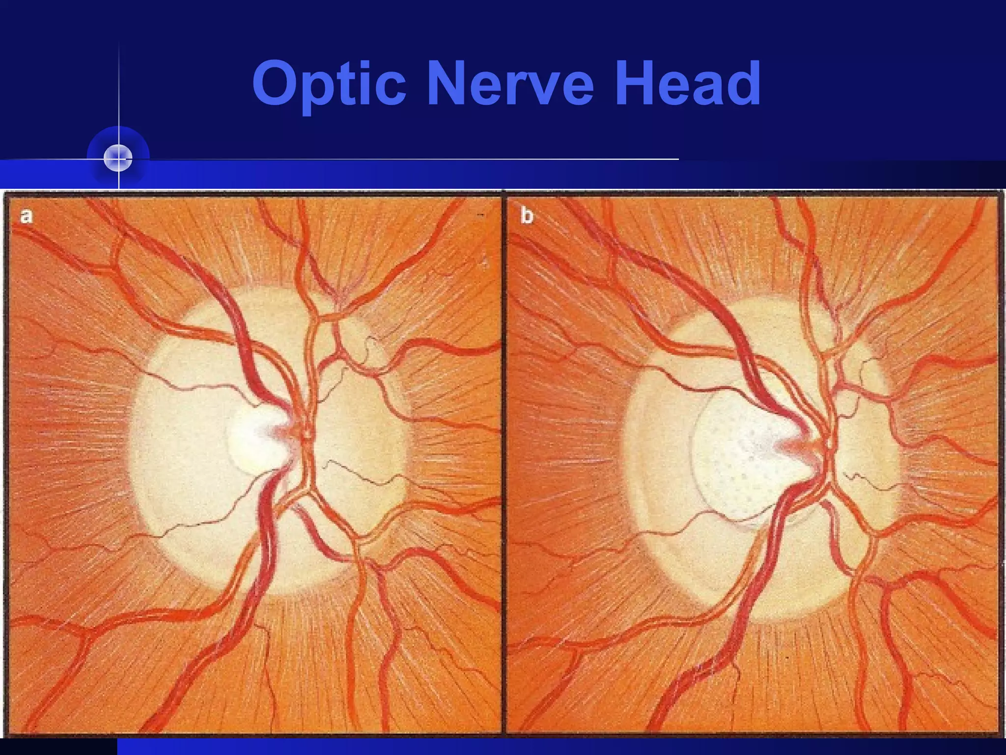 Optic Nerve Head
 