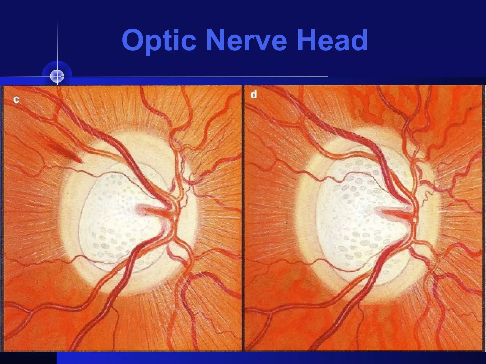 Optic Nerve Head
 