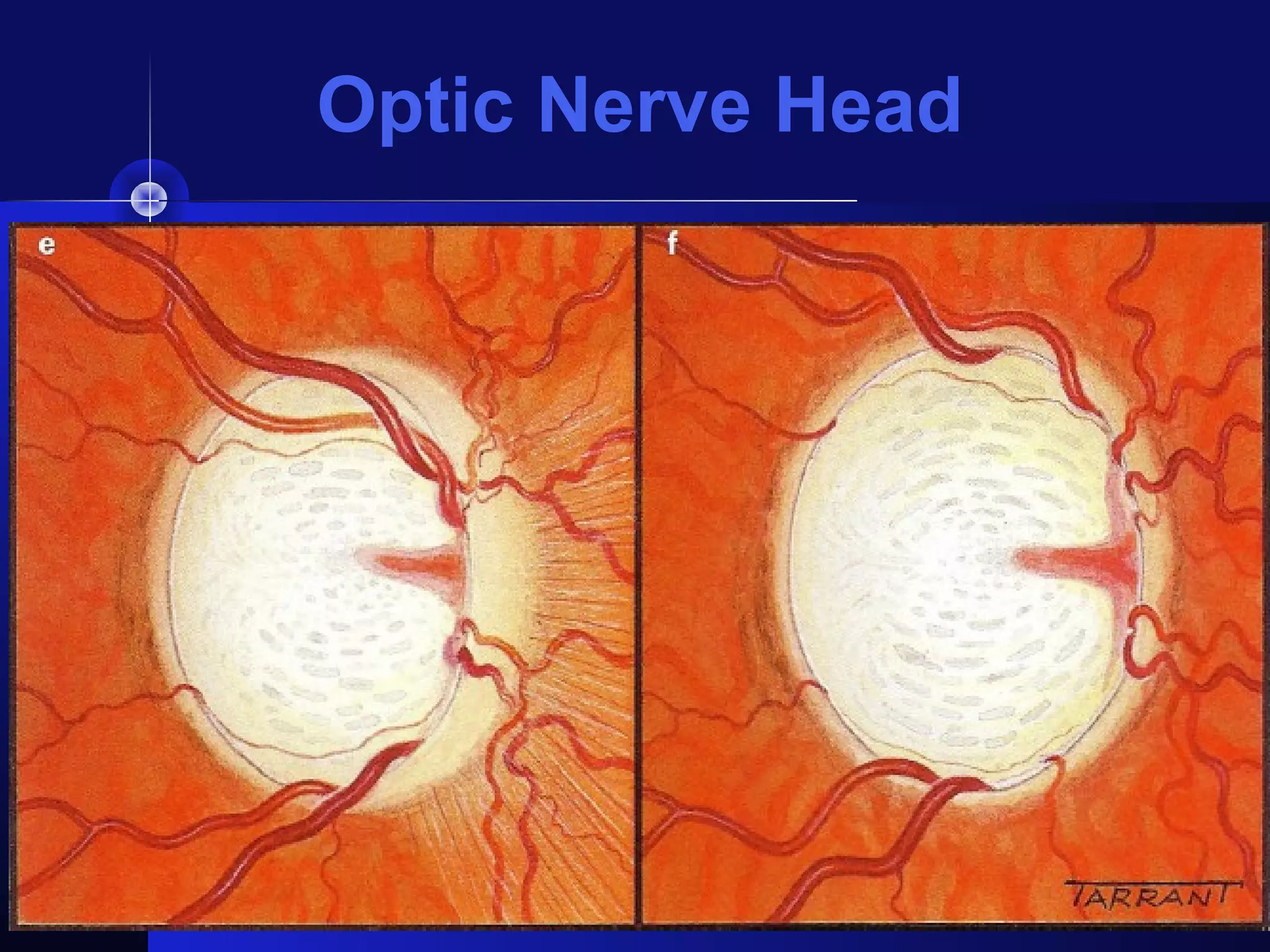 Optic Nerve Head
 
