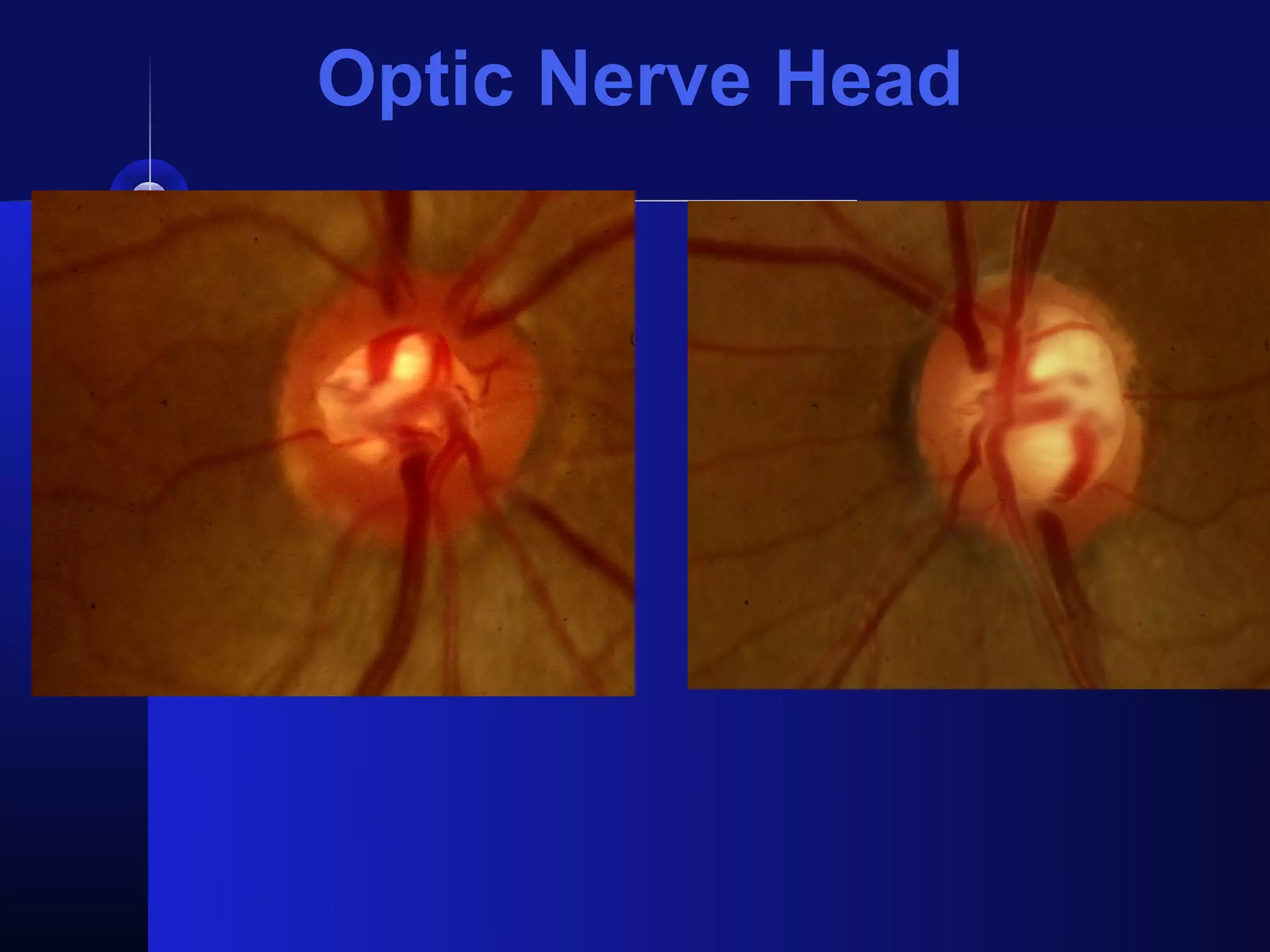 Optic Nerve Head
 