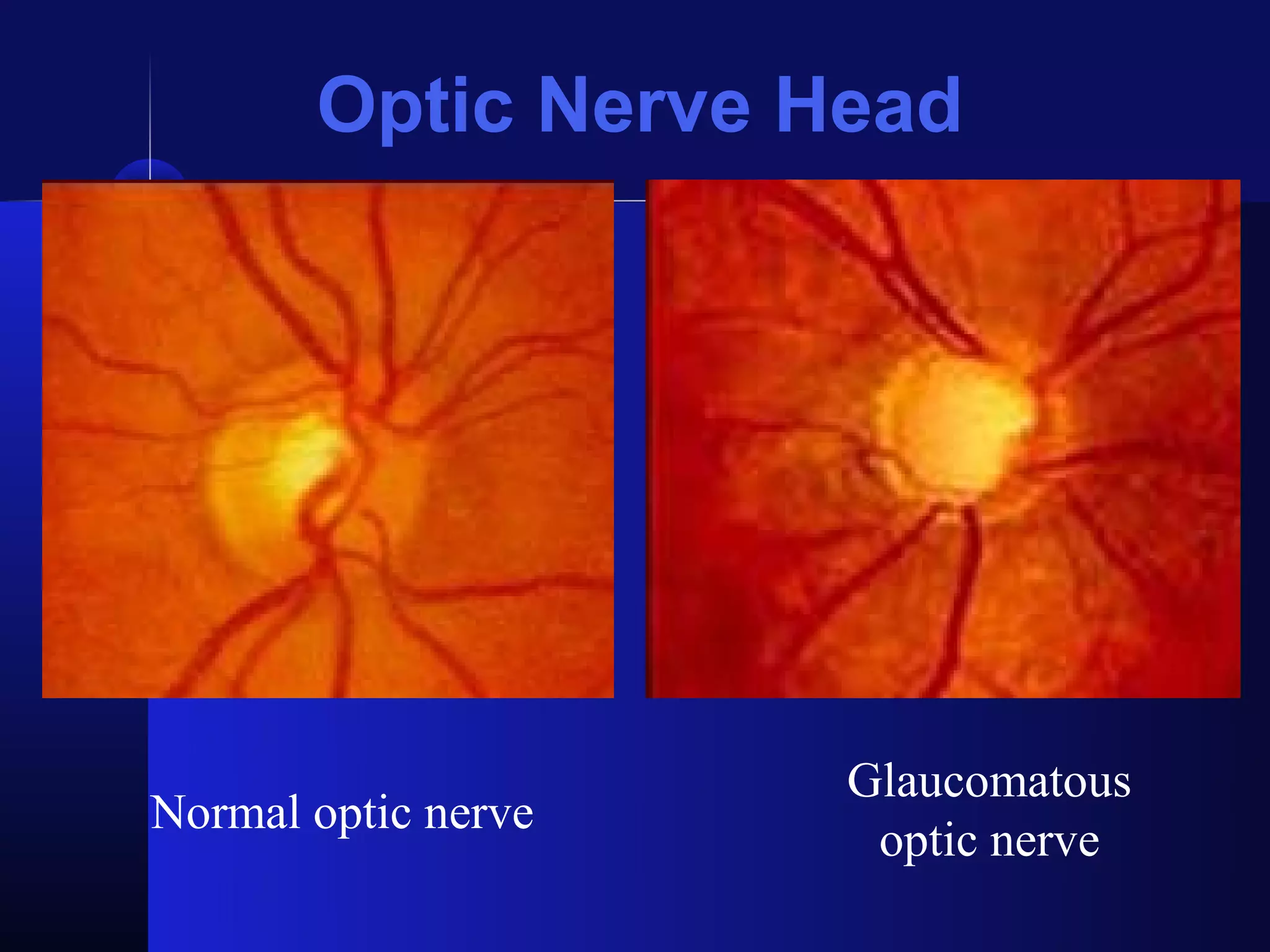 Optic Nerve Head




                     Glaucomatous
Normal optic nerve
                      optic nerve
 