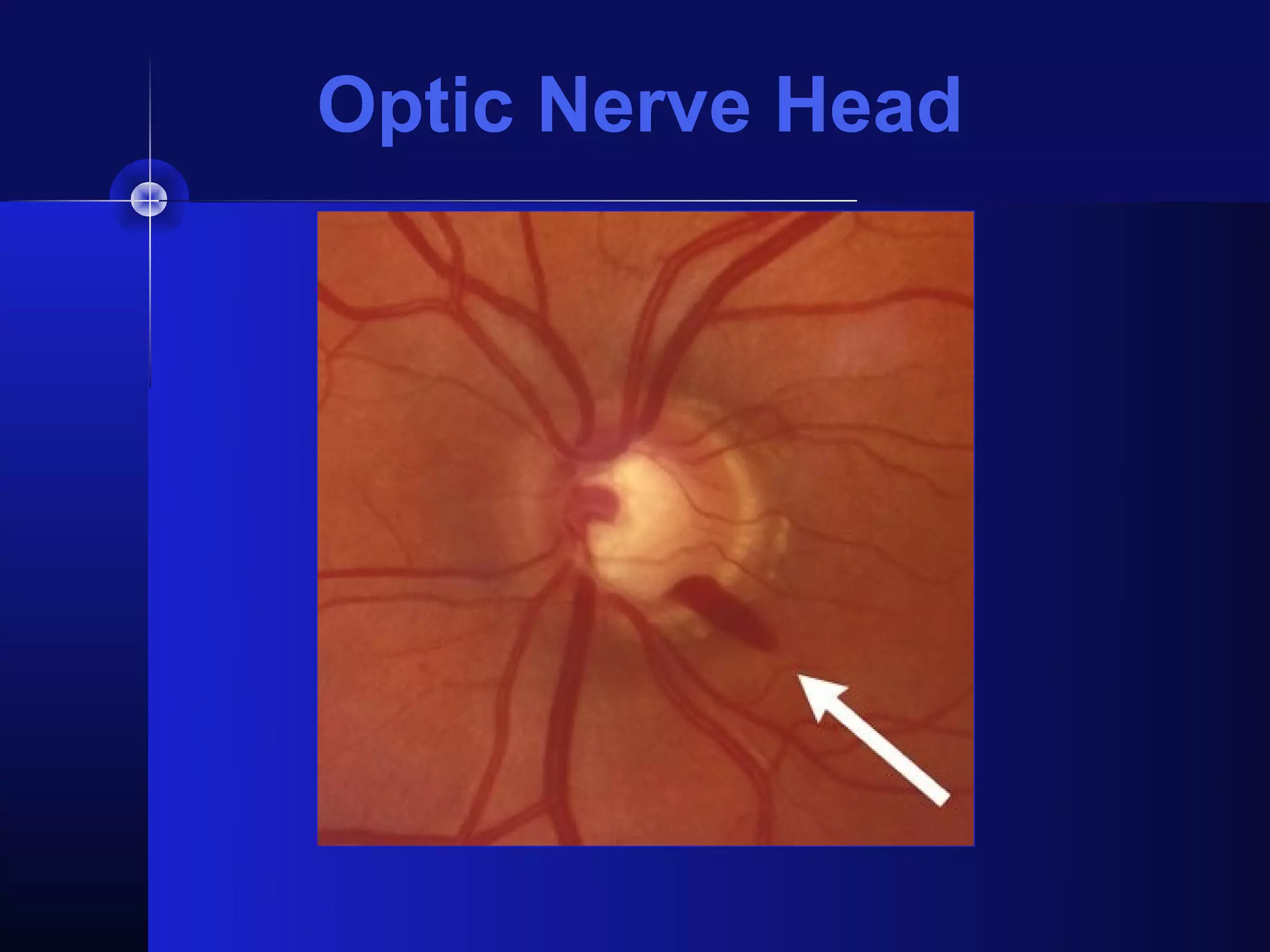 Optic Nerve Head
 
