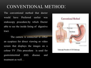 The conventional method that doctor
would have Preferred earlier was
endoscopy procedure.by which Doctor
able to see the inside lining of digestive
tract.
The camera is connected to either
an eyepiece for direct viewing or video
screen that displays the images on a
colour TV .This procedure is used for
gastrointestinal (GI) disease and
treatment as well…
CONVENTIONAL METHOD:
 