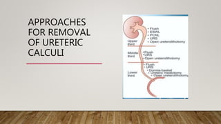 APPROACHES
FOR REMOVAL
OF URETERIC
CALCULI
 