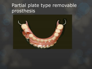 Comprehensive Guide to Partial Plate Type Removable Prosthesis ...