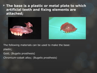Comprehensive Guide to Partial Plate Type Removable Prosthesis ...