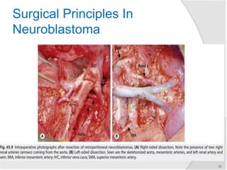 Surgical Principles In
Neuroblastoma
 Approach depends on
 Exact tumor location of the tumor
 Tumor size
 The extent of vascular encasement
13
►Operative principles
1. Approach the operation as a vascular-
type operation
 Identification and skeletonization of the
major vessels
 Dissecting in a subadventitial plane
2. The tumor should be removed
piecemeal
3. Dissection starts distal to the lower edge
of the tumor, along the common or
external iliac artery, and proceeds
proximally
 