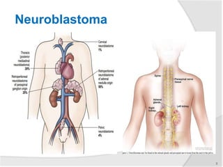 Neuroblastoma
This is a neoplasm of neural crest origin,
arising in the adrenal medulla and along
the sympathetic ganglion chain from the
neck to the pelvis
 Arise during fetal or early postnatal
life
 Is the most common extra cranial
solid tumors in children
 10% of all childhood cancer and 15%
of all cancer deaths
 Incidence 1 in 7500 – 10,000 children
 40% in children younger than 1yr, 75% at age
7 and 98% at age 10
 More than 50% occur in children under 2yrs of
age
 Boys : Girls = 1.2:1
 Majority occur sporadically but familial NB
occur in 2% of cases
 Primary Sites of tumor:
 Abdominal cavity 75%
Adrenal medulla 50%
Para spinal ganglia 25%
 Posterior mediastinal 20%
 Pelvic 4%
 Cervical 1%
3
 