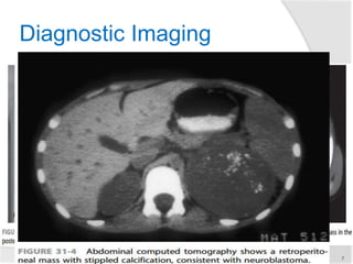 Diagnostic Imaging
 Radiographs
 Fine calcification and as
mediastinal and mediastinal
mass
 CT scan
 Calcification in ~ 85% of tumors,
and intraspinal extension of the
tumor on contrast-enhanced CT
 Overall, contrast-enhanced CT
has 82% accuracy in defining
neuroblastoma extent, with the
accuracy increasing to nearly
97% when performed with a
bone scan
7
►Imaging findings
 Stippled calcification or
LN with calcification
 Displace the kidney
inferiorly
 Crossing the midline
 Encasing/displace vessels
 Paravertebral mass—
spinal extension
 