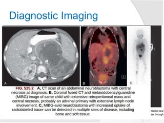 Diagnostic Imaging
 MRI
 More accurate than CT for detection
of stage 4 disease
○ The sensitivity of MRI is 83%(CT-
43%) and the specificity of MRI is
97%(CT-88%)
○ Metastases to the bone and bone
marrow and intraspinal tumor
extension are better detected by
MRI
 MIBG bone scintigraphy
 82% sensitivity and 91% specificity
for detection of metastases to the
bone and bone marrow
 Required imaging studies
○ CT and/or MRI to address IDRFs is
mandatory for imaging the primary
tumor and metastatic sites
○ MIBG scintigraphy is mandatory
to define metastatic disease.
8
 