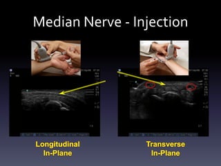 Medial Injection Ultrasound Guided Injections - Upper Extremity | PDF
