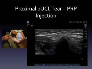 Ultrasound Guided Injections - Upper Extremity