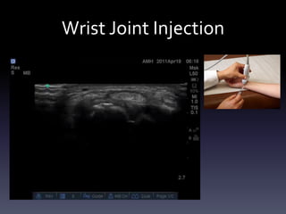 Ultrasound Guided Injections - Upper Extremity
