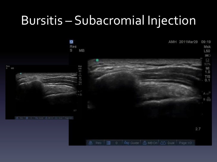 Subacromial Bursitis Natural Treatment Subacromial Bursitis Natural Treatment