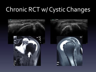 Shoulder Rtc Syndrome Ultrasound - Shoulder | PDF