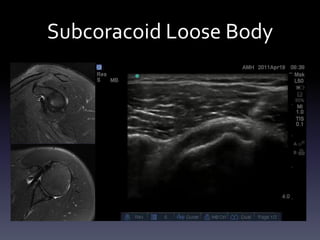 Ultrasound - Shoulder