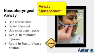 Nasopharyngeal
Airway
● Use correct size
● Better tolerated
● Use most patent nose
● Avoid in midfacial
injuries
● Avoid in fracture base
of skull
Airway
Management
 