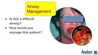 ● Is this a difficult
airway?
● How would you
manage this patient?
Airway
Management
 