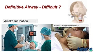 Definitive Airway - Difficult ?
Superior Laryngeal nerve block
Awake Intubation
 