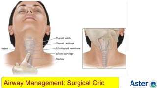 Airway Management: Surgical Cric
 