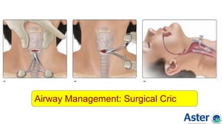 Airway Management: Surgical Cric
 