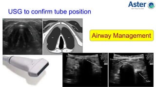 USG to confirm tube position
Airway Management
 