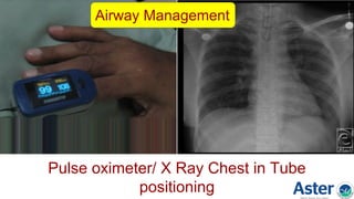 Pulse oximeter/ X Ray Chest in Tube
positioning
Airway Management
 