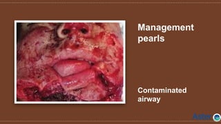 Management
pearls
Contaminated
airway
 