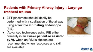 Patients with Primary Airway injury : Laryngo
tracheal trauma
● ETT placement should ideally be
performed with visualization of the airway
using a flexible intubating endoscope
(FIE).
● Advanced techniques using FIE either
primarily in an awake patient or assisted
by VL when an RSI is chosen are
recommended when resources and skill
are available.
 