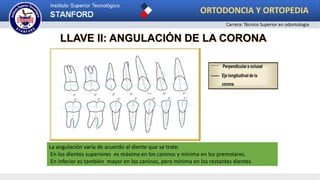 LLAVE II: ANGULACIÓN DE LA CORONA
La angulación varía de acuerdo al diente que se trate.
En los dientes superiores es máxima en los caninos y mínima en los premolares.
En inferior es también mayor en los caninos, pero mínima en los restantes dientes.
ORTODONCIA Y ORTOPEDIA
Carrera: Técnico Superior en odontología
 
