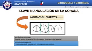 LLAVE II: ANGULACIÓN DE LA CORONA
Angulaciones positivas:
Cuando la porción gingival del diente está situada distal a la incisal
Angulaciones negativas:
Cuando la porción gingival está situada mesial a la incisal.
ORTODONCIA Y ORTOPEDIA
Carrera: Técnico Superior en odontología
 