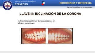Inclinaciones correctas de las coronas de los
dientes posteriores:
LLAVE III: INCLINACIÓN DE LA CORONA
ORTODONCIA Y ORTOPEDIA
Carrera: Técnico Superior en odontología
 