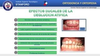 Mordida abierta anterior simétrica
Protrusión de dientes anterosuperiores y aparición
de distemas
Labio superior hipotónico e inferior hipertónico
Hipertoncidad del musculo de la borda del mentón
Hiperactividad de los músculos de la masticación
Inhibición del crecimiento vertical del proceso
alveolar
Incompetencia labial
Problemas fonéticos
ORTODONCIA Y ORTOPEDIA
Carrera: Técnico Superior en odontología
 