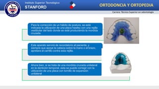 Para la corrección de un hábito de postura, se está
indicada la utilización de una placa hawley con una rejilla
vestibular del lado donde se esté produciendo la mordida
cruzada.
Este aparato servirá de recordatorio al paciente, y
siempre que apoye la cabeza sobre la mano o el brazo,
apretara el carrillo contra esta rejilla.
Ahora bien, si se trata de una mordida cruzada unilateral
en la dentición temporal, esta se puede corregir con la
utilización de una placa con tornillo de expansión
unilateral
ORTODONCIA Y ORTOPEDIA
Carrera: Técnico Superior en odontología
 