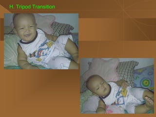 H. Tripod Transition
 