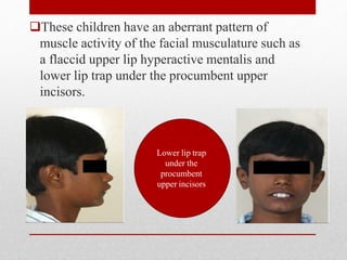 These children have an aberrant pattern of
muscle activity of the facial musculature such as
a flaccid upper lip hyperactive mentalis and
lower lip trap under the procumbent upper
incisors.
Lower lip trap
under the
procumbent
upper incisors
 