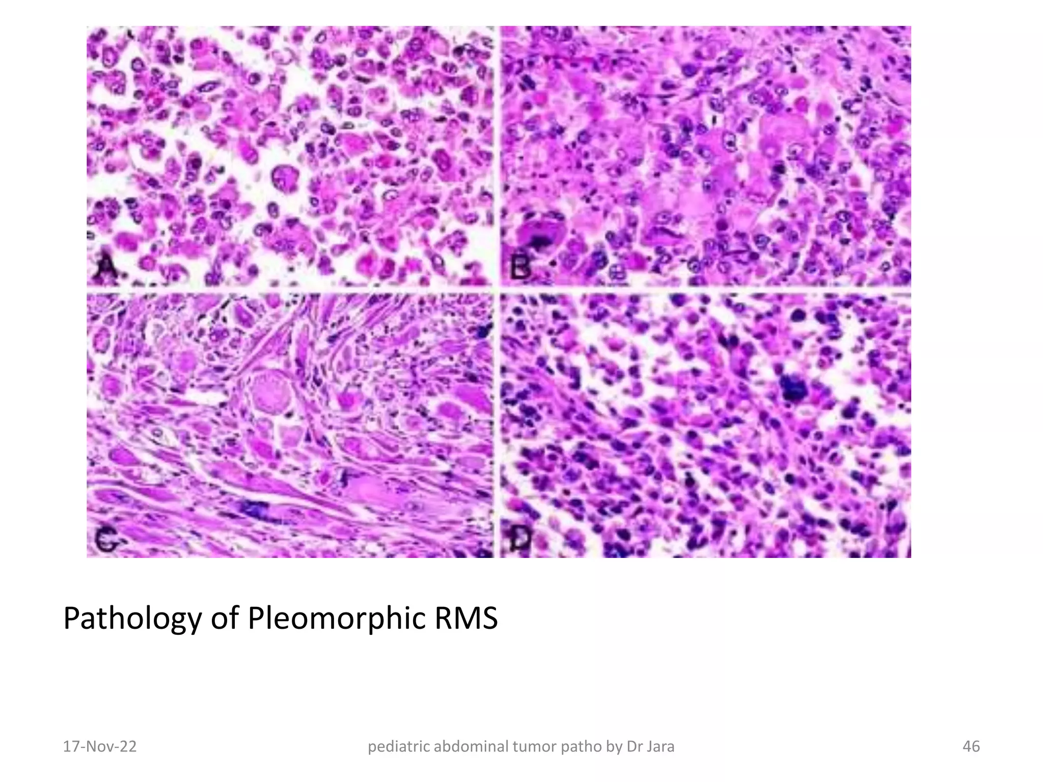 Pleomorphic Rms Pathology of pediatric tumors | PPTX