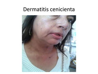 Dermatitis cenicienta
 