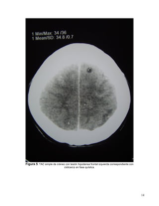 14
Figura 5: TAC simple de cráneo con lesión hipodensa frontal izquierda correspondiente con
cisticerco en fase quística.
 