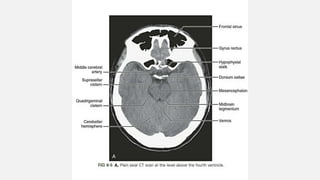 Ncct and cect brain and orbit | PPTX