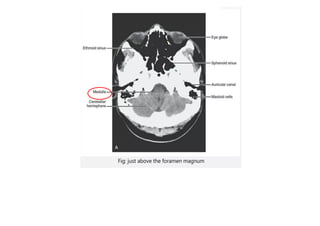 Ct Head Tutorial NCCT BRAIN Tutorial.pdf it have details of brain | PDF