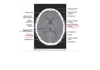 Ct Head Tutorial NCCT BRAIN Tutorial.pdf it have details of brain | PDF