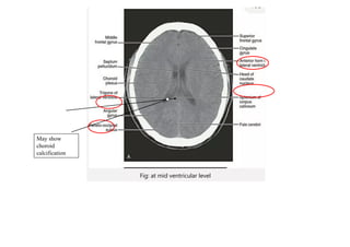 Ct Head Tutorial NCCT BRAIN Tutorial.pdf it have details of brain | PDF
