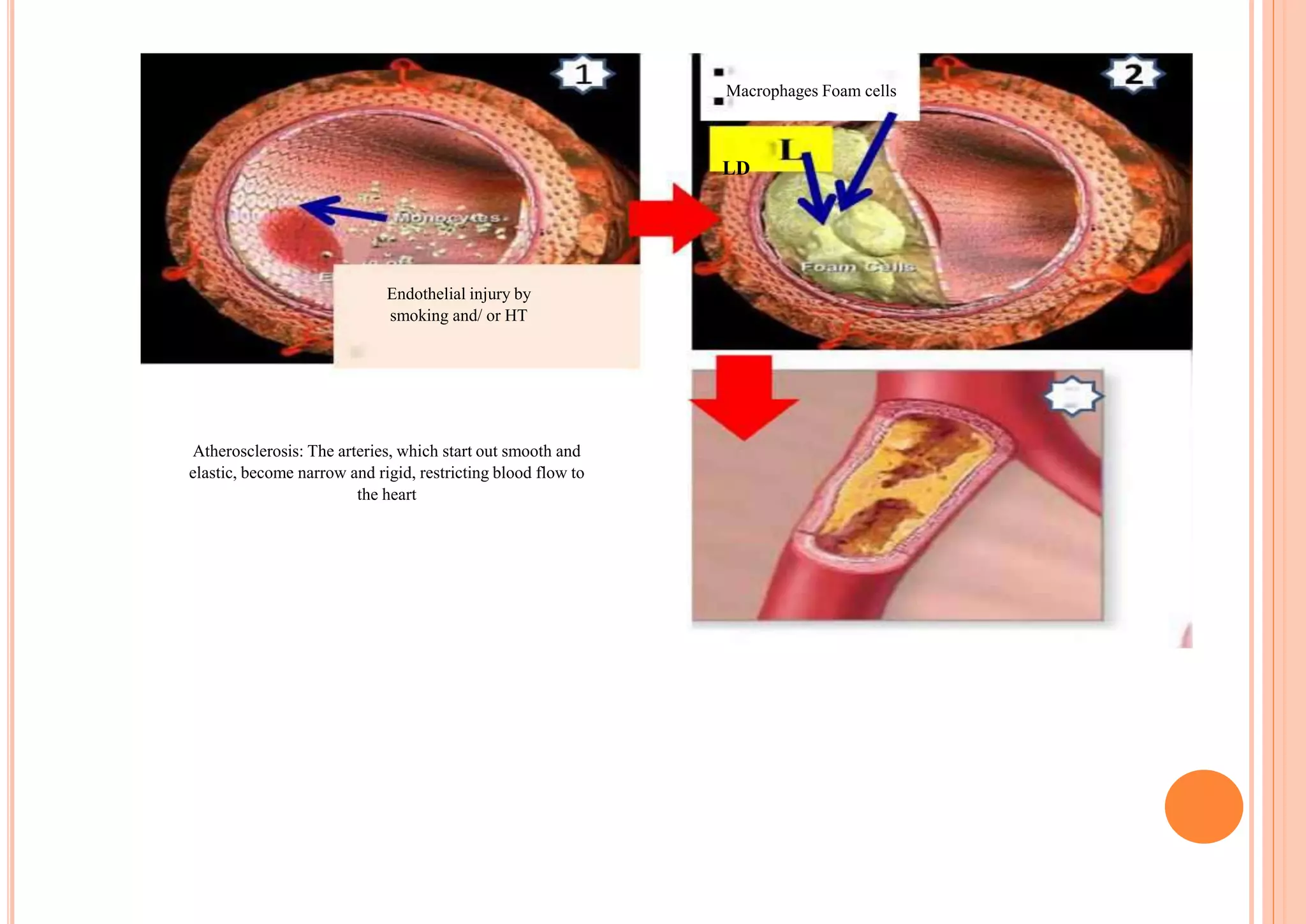 Macrophages Foam cells
LD
Endothelial injury by
smoking and/ or HT
Atherosclerosis: The arteries, which start out smooth and
elastic, become narrow and rigid, restricting blood flow to
the heart
 