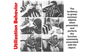UtilizationBehavior
The
tendency
to grasp
common
objects
when
presented,
and
perform
the
function
commonly
associated
with the
object.
 