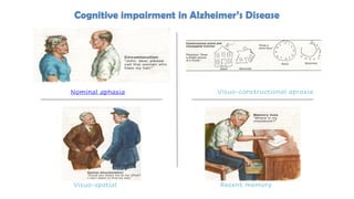 Nominal aphasia
Visuo-spatial
Visuo-constructional apraxia
Recent memory
Cognitive impairment in Alzheimer’s Disease
 